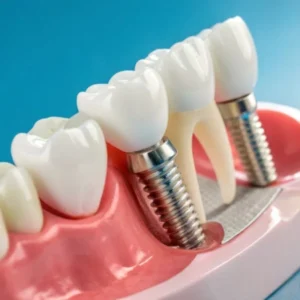IMPLANTE DENTAL + CORONA