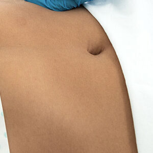 DEPILACIÓN LÁSER ABDOMEN (6 SESIONES)