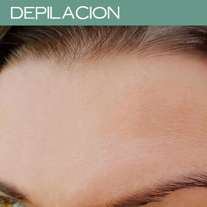 DEPILACIÓN LÁSER FRENTE (8 SESIONES)